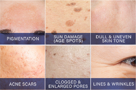 Dr. LeWinn's Reversaderm targets multiple skincare concerns for a flawless complexion such as pigmentation, sun damage, age spots, dull uneven skin tone, acne scars, clogged pores, and lines & wrinkles.